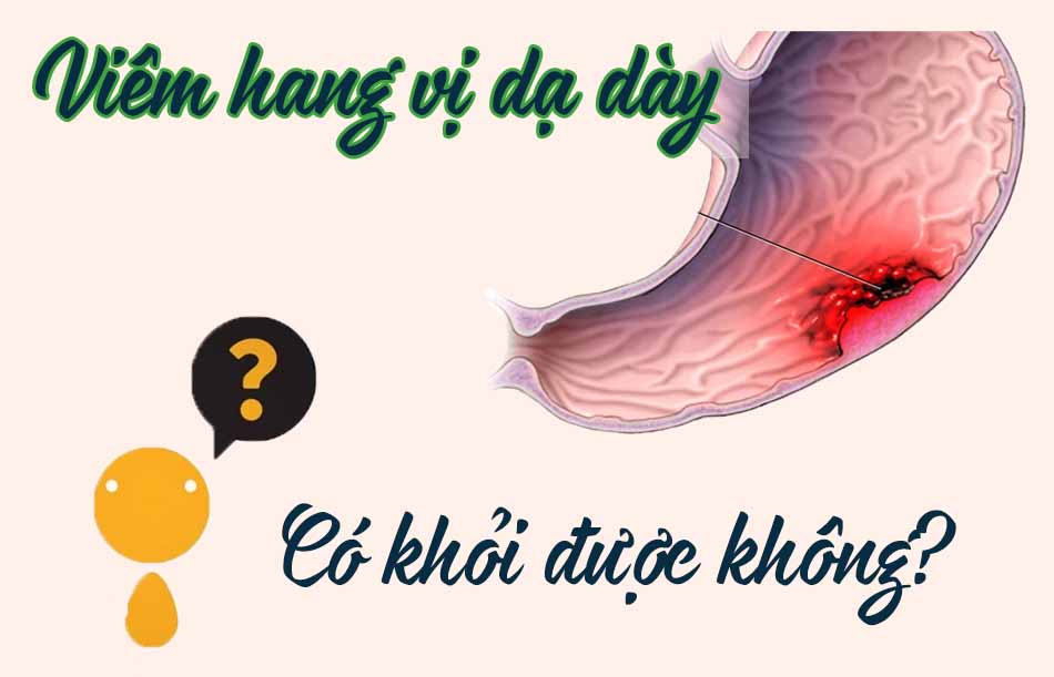 Viêm hang vị dạ dày có khỏi được không?