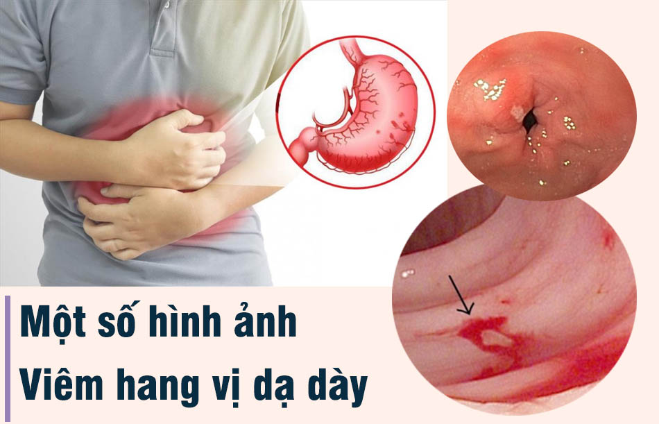 Một số hình ảnh viêm hang vị dạ dày