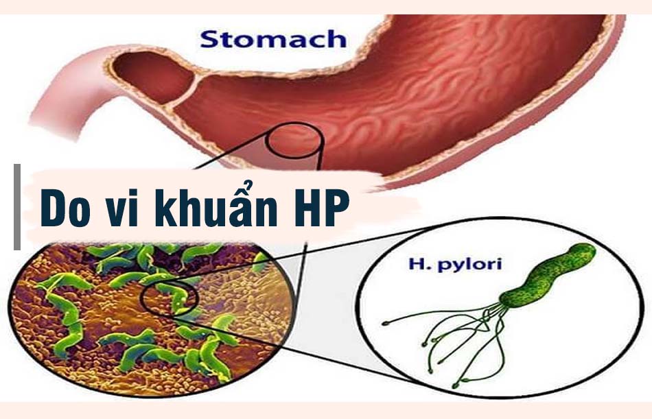 Do vi khuẩn HP gây nên