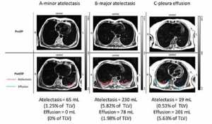 Hình 2. MRI phổi trước và ngày đầu sau phẫu thuật bụng mở. Hình ảnh từ bệnh nhân tự thở và thể hiện thể tích phổi toàn phần (TLV) trung bình trong các chu kỳ thờ. (A) Xẹp phổi ít, (B) xẹp phổi nhiều, (C) tràn dịch màng phổi. Các phần của phổi, xẹp phổi (đường màu đỏ) và tràn dịch màng phổi (đường màu xanh). Các trị số được tính toàn theo thể tích phổi toàn phần. Lưu ý số lượng xẹp phổi và tràn dịch màng phổi, 2 biến chứng hô hấp hậu phẫu thường gặp nhất, là tương đối thấp sau mổ. L = left side of chest; N/A = arbitrary gray scale; PostOP = postoperative; PreOP = preoperative; R = right side of chest.