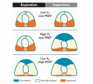 Hình. 3. Tác động của thể tích khí lưu thông (VT) thấp và cao ở cuối thì hít vào và cuối thì thở ra với PEEP thấp và cao trong thời gian gây mê. Vùng xẹp phổi (đỏ), vùng quá chướng (xanh), và vùng phổi bình thường (trắng). Khi thông khí với VT thấp và PEEP thấp, xẹp phổi nhiều hơn ở cuối thì thở ra và quá chướng phế nang ít ở cuối thì hít vào; khi thở máy với VT cao và PEEP thấp, có ít xẹp phổi ở cuối thì thở ra và cuối thì hít vào, kèm theo tăng vùng quá chướng ở cuối thì hít vào. Hơn nữa có số lượng lớn của vùng mô xẹp và hết xẹp trong chu kỳ thở. Thông khí với VT thấp và PEEP cao, ít xảy ra xẹp phổi, nhưng có quá chướng phế nang ở cuối thì hít vào và cuối thì thở ra, kèm theo tối thiểu hiện tượng xẹp/mở trong chu kỳ thở.