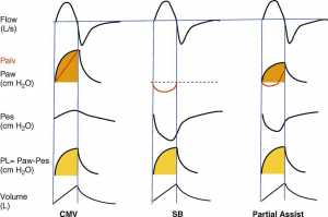 Hình 1. Minh họa áp lực xuyên phổi được hình thành như thế nào bởi nhịp thở cơ học trong quá trình thông khí cơ học được kiểm soát, nhịp tự thở, hoặc sự kết hợp của cả hai trong suốt quá trình hỗ trợ hô hấp một phần. Từ trên xuống dưới: lưu lượng, áp lực phế nang (màu đỏ) và áp lực đường thở mở, áp lực thực quản, áp lực xuyên phổi tính toán, và thể tích khí lưu thông. CMV = controlled mechanical ventilation; Palv = alveolar pressure; Paw = airway opening pressure; Pes = esophageal pressure swings; PL = transpulmonary pressure; SB = spontaneous breath.
