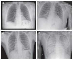 Hình 3: X quang phổi của bệnh nhân bị TRALI. Đây là x quang phổi của 2 bệnh nhân trước (A, C) và sau (B, D) khí khởi phát TRALI. Hình A và C cho thấy giường mạch máu phổi bình thường không có dấu hiệu phù phổi; B và D cho thấy các thay đổi thầm nhiễm gợi ý phù phổi. D cho thấy hình ảnh thâm nhiễm phổi 2 bên nặng, kinh điển cho TRALI; tuy nhiên , thường là các hình ảnh thay đổi ít nặng hơn, như ở hình B.