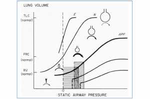 Hình 6. Sử dụng đường cong áp lực/thể tích (P/V) để cá nhân hóa PEEP. Hình dạng của đường cong P/V thay đổi từ bình thường (N) và khác nhiều với tình trạng khí phế thũng (E) hoặc suy hô hấp cấp (APF). Mối quan hệ P/V trong quá trình thông khí khí lưu thông được mô tả trong vùng bóng rào có và không có PEEP. RV khu vực thể tích mà tại đó xẹp phế nang, FRC dung tích cặn chức năng, và TLC dung tích phổi toàn phần. Bản vẽ trung tâm về sự thay đổi kích thước của phế nang dọc theo đường cong P/V [91]