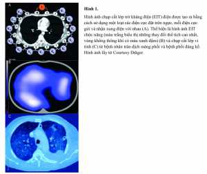 Hình 1. Hình ảnh chụp cắt lớp trở kháng điện (EIT) điện được tạo ra bằng cách sử dụng một loạt các điện cực đặt trên ngực, mỗi điện cực gửi và nhận xung điện với nhau (A). Thể hiện là hình ảnh EIT chức năng (màu trắng biểu thị những thay đổi thể tích cao nhất, vùng không thông khí có màu xanh đậm) (B) và chụp cắt lớp vi tính (C) từ bệnh nhân tràn dịch màng phổi và bệnh phổi đáng kể. Hình ảnh lấy từ Courtesy Dräger.