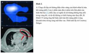 Hình 2. A: Chụp cắt lớp trở kháng điện chức năng của bệnh nhân bị tràn khí màng phổi. Lưu ý phần màu đen ở phía trên bên phải của hình thứ hai [2]; điều này có nghĩa là trở kháng không thay đổi trong vùng đó, và do đó không có khối lượng nào thay đổi. B: Hình CT tương ứng thể hiện một tràn khí màng phổi (vùng khoanh tròn) trong cùng một khu vực. Hình ảnh lấy từ Courtesy Dräger.