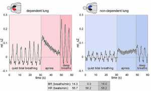 Hình 2: Dạng sóng chụp cắt lớp điện trở (EIT) đồng thời được đăng ký tại một điểm ảnh ở vùng lưng của phổi phụ thuộc (trái) và ở một điểm ảnh khác ở vùng lưng của phổi không phụ thuộc (phải) trong một người đàn ông khỏe mạnh 43 tuổi, nằm nghiêng bên phải. Dữ liệu thô thu được bằng cách sử dụng thiết bị GoE-MF II EIT (CareFusion, Höchberg, Đức) và được xây dựng lại bằng thuật toán GREIT. Trong 30 giây đầu tiên, chủ thể đang thở nhẹ nhàng, sau đó anh được hướng dẫn để giữ hơi thở của mình trong 20 giây sau khi hít vào, cuối cùng anh hít thở ba hơi thật sâu. Những thay đổi liên quan đến thông khí định kỳ của tín hiệu EIT, được cho là sự thay đổi trở kháng tương đối (rel. ΔZ), cao hơn những thay đổi liên quan đến tác động của tim. (Tác động của tim nhìn thấy tốt nhất trong giai đoạn ngưng thở.) Những thay đổi theo chu kỳ thở trong rel. ΔZ ở giai đoạn đầu tiên và thứ ba của phép đo này cao hơn ở phổi phụ thuộc so với phổi không phụ thuộc phản ánh thông khí sinh học cao hơn của các vùng phổi phụ thuộc ở các đối tượng người lớn tự thở ở mức dung tích cặn chức năng. Trong giai đoạn ngưng thở, tín hiệu EIT rơi liên tục trong vùng phổi phụ thuộc do mất thể tích khí cục bộ gây ra do trao đổi khí liên tục. Điều này không được quan sát thấy trong phổi không phụ thuộc. Những thay đổi trong rel. ΔZ đồng bộ với nhịp tim có biên độ tương đương ở cả hai điểm ảnh. Tần số thở (BR) và nhịp tim (HR) trong mỗi giai đoạn kiểm tra được đưa ra ở phần dưới của hình được lấy từ việc lọc tần số tín hiệu EIT.