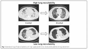 Example of lung CT scan of patients with high (upper panel) or low (lower panel) potential of lung recruitment