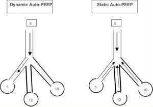 Hình 5. Auto-PEEP động và tĩnh. Trong lưu lượng hít vào auto-PEEP động bắt đầu ngay khi áp lực đường thở lớn hơn ở vùng phổi với mức auto-PEEP thấp nhất, tức là thời gian ngắn nhất (Dynamic auto-PEEP trong ví dụ này là 5). Trong khi auto-PEEP tĩnh ngưng thì thở ra cho phép cân bằng vùng phổi và đo PEEP tự động là trung bình của tất cả các vùng (Static auto-PEEP trong ví dụ này là 10).