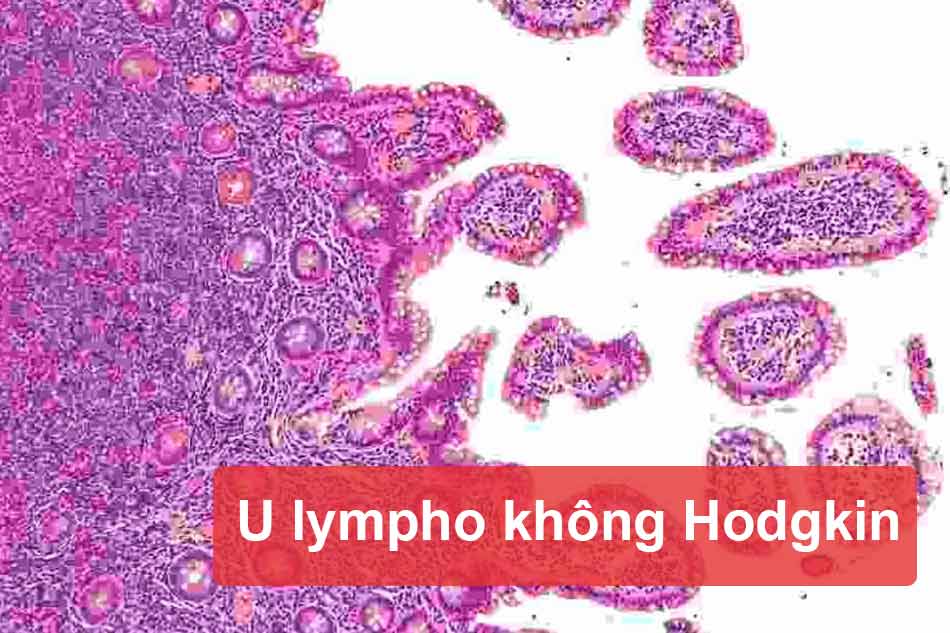 U lympho không Hodgkin