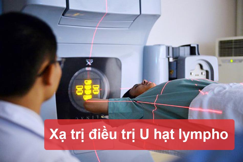 Xạ trị điều trị U hạt Lympho