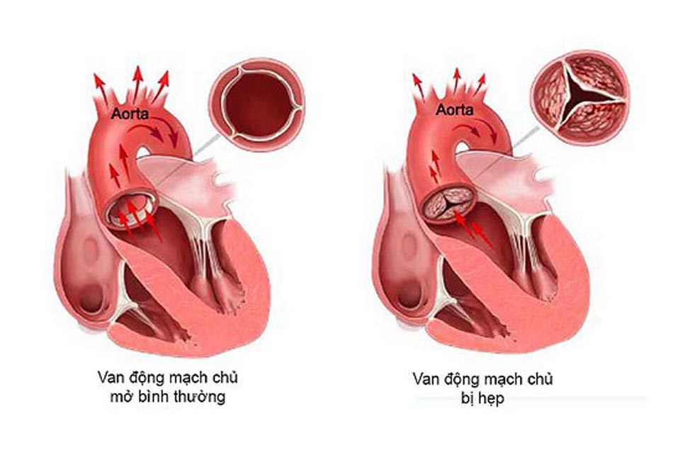 Hẹp van động mạch chủ