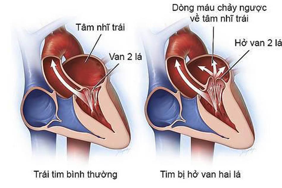 Hở van hai lá