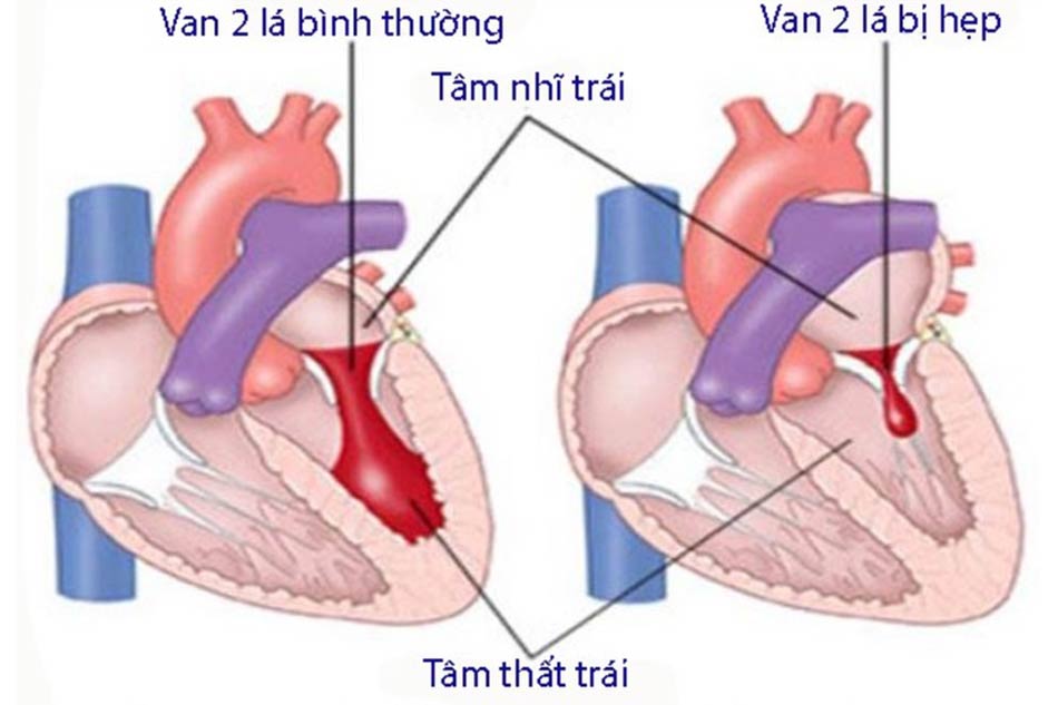 Hẹp van hai lá