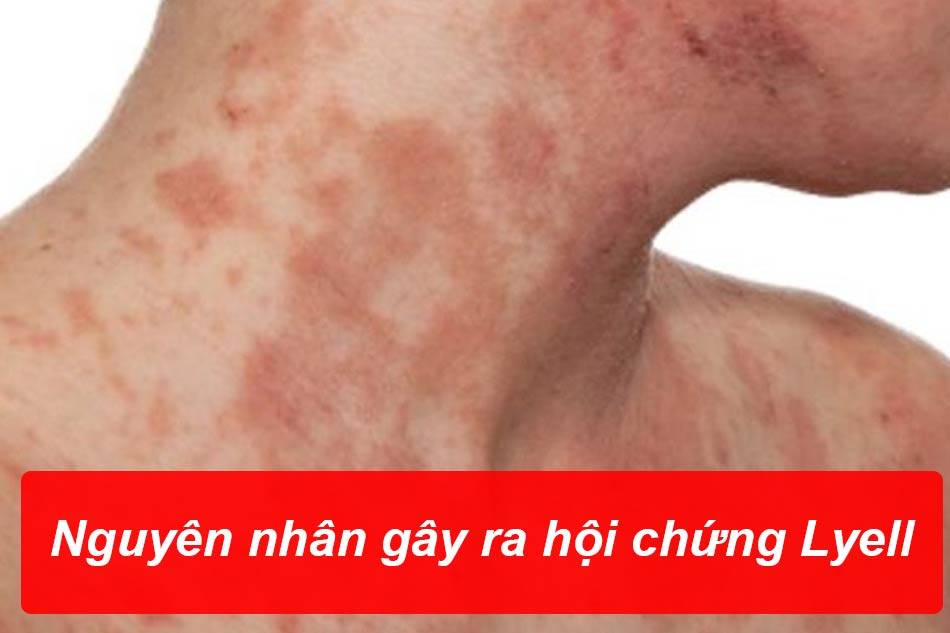 Nguyên nhân của hội chứng Lyell