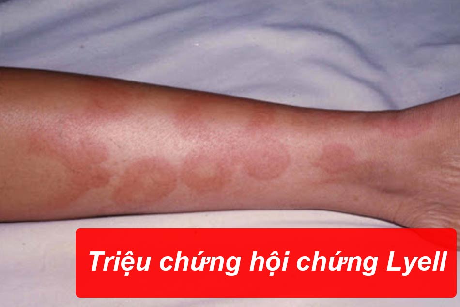 Triệu chứng hội chứng Lyell