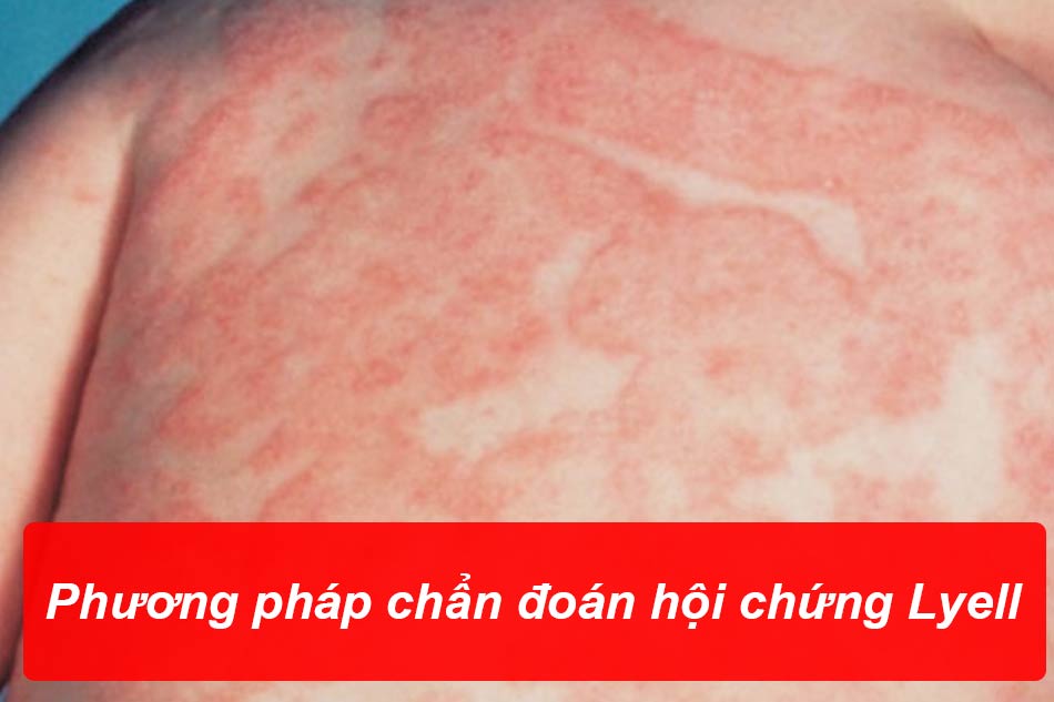 Phương pháp chẩn đoán hội chứng Lyell