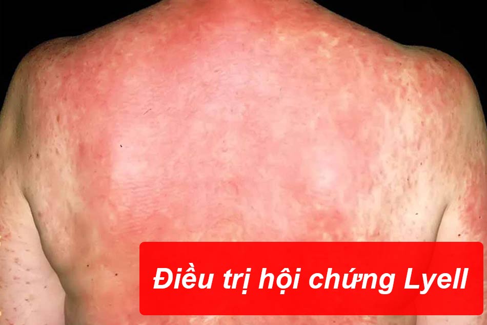 Phương pháp điều trị hội chứng Lyell