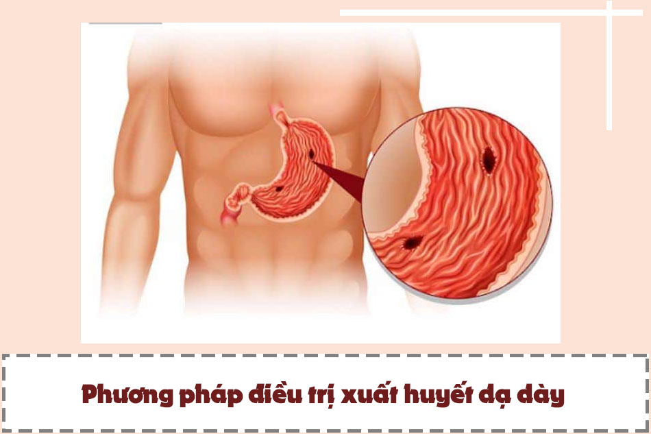 Phương pháp điều trị xuất huyết dạ dày hiện nay