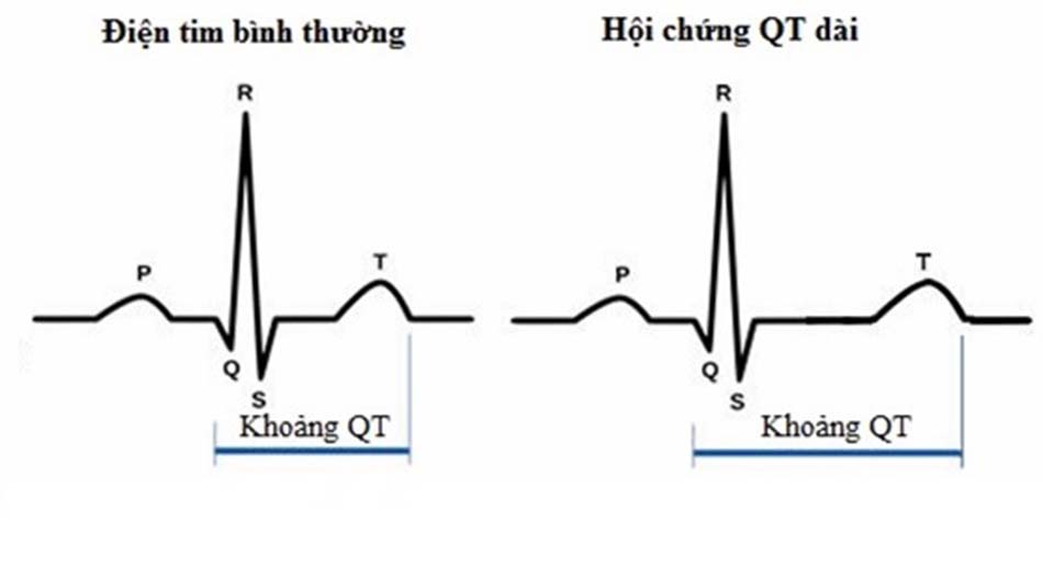 khoảng QT