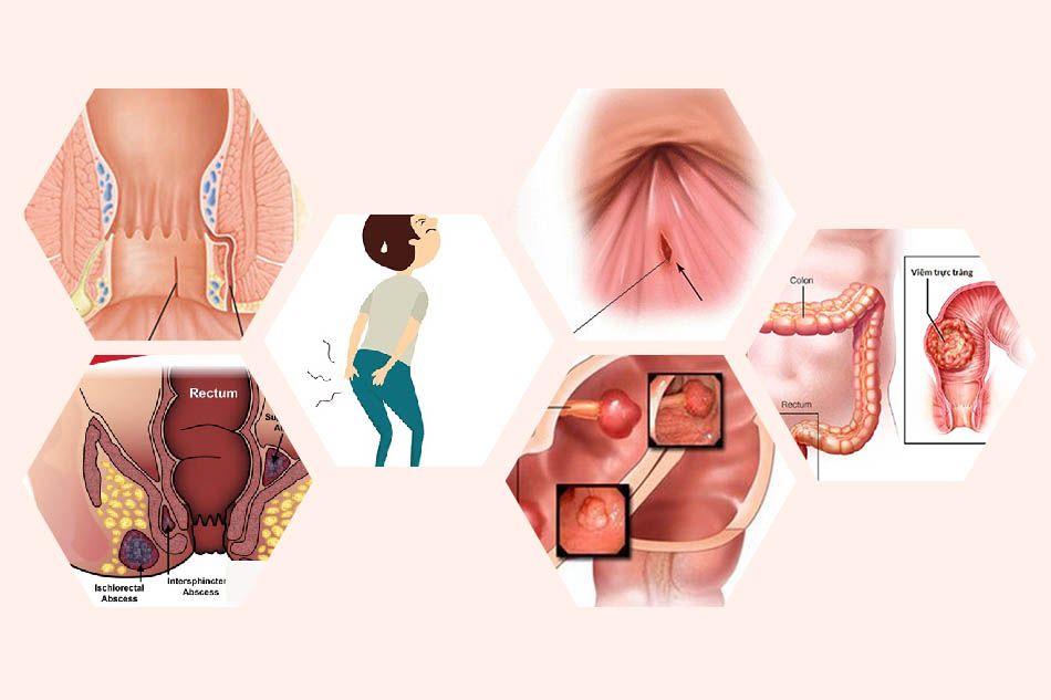 Nóng rát hậu môn là dấu hiệu của bệnh gì?