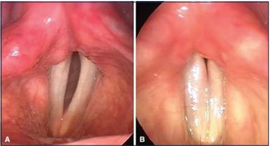 HÌNH 10-1: A: trước khi tiêm chất làm đầy. B: sau khi tiêm chất làm đầy