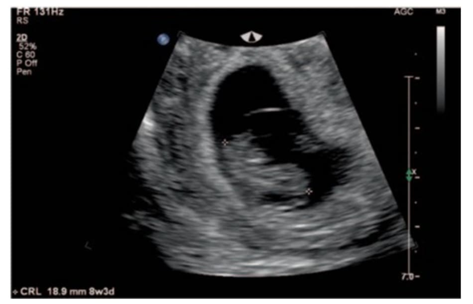 Hình 10.1 Siêu âm qua ngả âm đạo cho thấy thai trong tử cung bình thường, 8 tuần + 3 ngày.