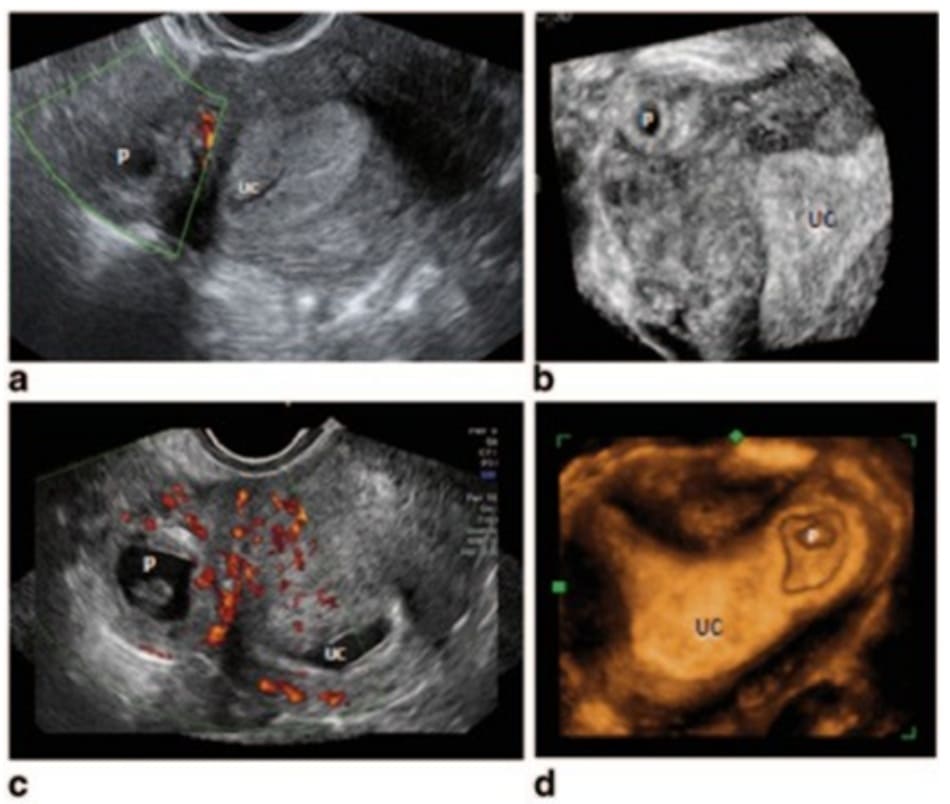 Hình 11.2 Hình ảnh TVUS qua ngả âm đạo một trường hợp EP. A: TVUS cho thấy buồng tử cung rỗng. B: TVUS 3D thấy hình ảnh thai ở mô kẽ vòi Fallope. C: thấy rõ buồng tử cung rỗng với khối thai nằm ngoài. D: TVUS 3D thấy 1 thai trong sừng trái tử cung, buồng tử cung trống.