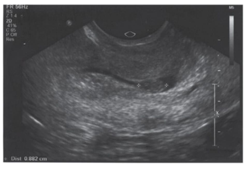 Hình 12.1 Hình ảnh siêu âm lát cắt dọc cho thấy một thai ở cổ tử cung (giữa hai dấu *)