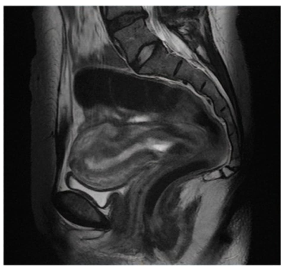 Hình 12.2 Hình ảnh chụp CHT mặt phăng sagittal thấy 1 khối thai ở vị trí cổ tử cung (tăng tín hiệu).