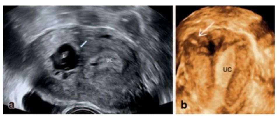 Hình 16.1 A: Hình ảnh siêu âm lát cắt ngang thấy 1 buồng tử cung trống (UC) ở phía bên trái. Túi thai chứa phôi (E) nằm độc lập với UC ở phía bên phải. Lưu ý có thể thấy phần màng rụng ở trong UC (mũi tên) nhưng không thấy xung quanh túi thai. B: Hình ảnh 3D sau điều trị, quét buồng tử cung trên mặt phẳng trán. Chú ý thấy không có phần màng rụng ở nửa trên bên phải buồng tử cung, giữa phần tử cung còn chức năng (UC) và mô kẽ vòi tử cung bên phải (mũi tên).