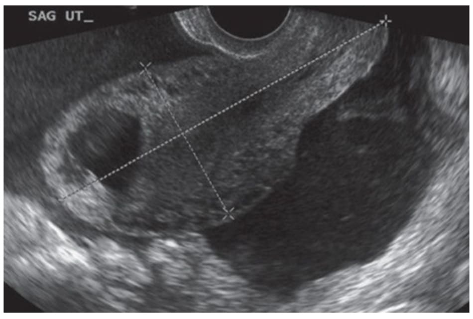 Hình 17.2 Buồng tử cung với khối thai bên trong, xung quanh là dịch ổ bụng.