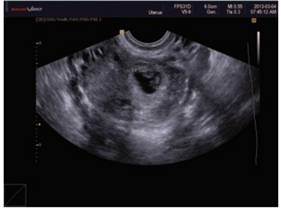 Hình 1.1 a Hình ảnh siêu âm thai ngoài tử cung trong vòi tử cung (EP) với đầy đủ cực phôi và túi noãn hoàng (yolk sac) trong túi thai. b Cũng một trường hợp thai trong vòi tử cung có hoạt động tim thai (siêu âm mode-M)