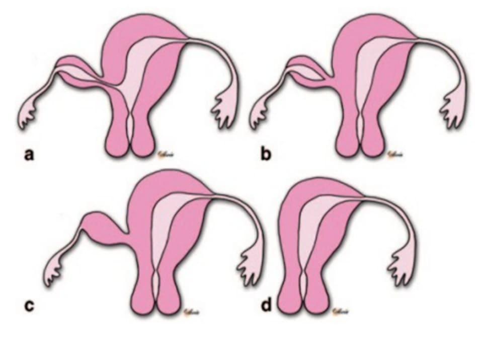 Hình 20.1 Các biến thể của tử cung 1 sừng: a: có khoang nội mạc và thông thương với sừng chính, b: có khoang nội mạc và không thông thương với sừng chính, c: sừng chột không có khoang nội mạc và liên tục với sừng chính và d: tử cung 1 sừng không có sừng chột.