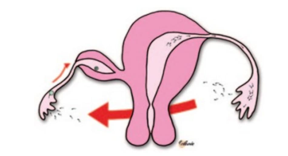 Hình 20.2 Mang thai sừng chột tử cung có khoang nội mạc nhưng không thông thương với sừng chính do tinh trùng di chuyển qua khoang phúc mạc vào loa vòi.