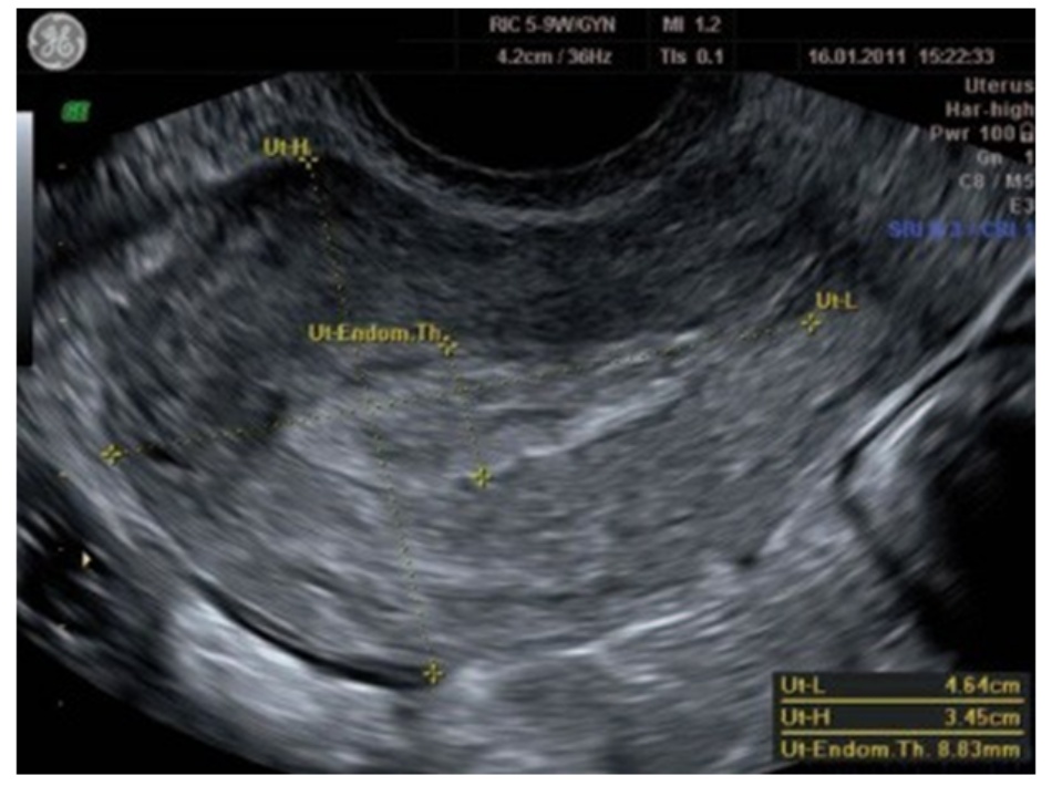 Hình 2.1 Siêu âm lát cắt dọc cho thấy dày nội mạc tử cung (Ut-Endom Th).