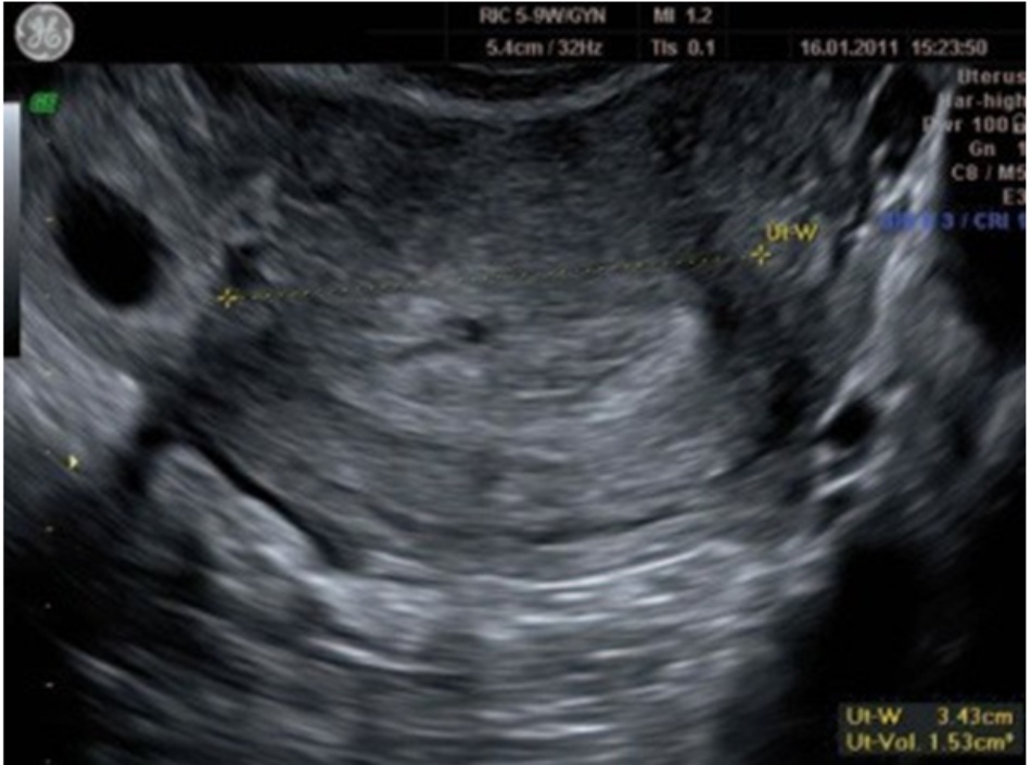 Hình 2.2 Hình ảnh siêu âm lát cắt ngang cho thấy túi thai giả trong buồng tử cung cùng với túi thai ở eo vòi tử cung bên trái. Hình 2.1 và 2.2 là của cùng một bệnh nhân. Như chúng ta đã thấy trên lát cắt dọc, nội mạc tử cung đang ở pha hoàng thể, định hướng tới một thai trong tử cung. Nhưng trên lát cắt ngang cho thấy bản chất thật của vấn đề. Với nồng độ B-hCG là 1500 IU/mL thì trường hợp EP này rất dễ bị bỏ sót.