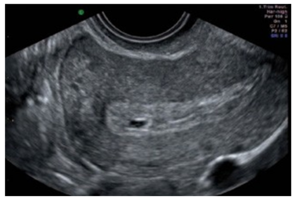 Hình 3.1 Một túi thai trong tử cung giai đoạn sớm có thể nhầm với túi thai giả