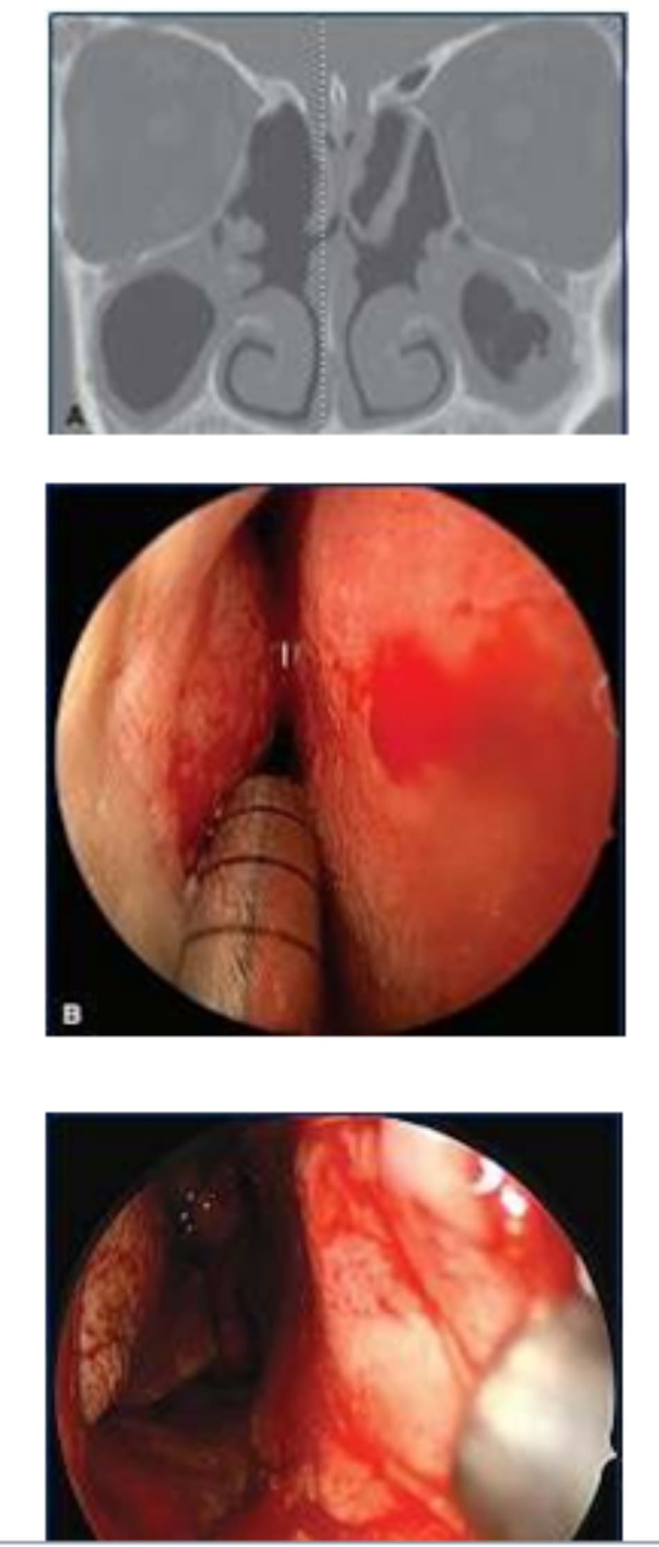 Figure 3–2. a. inferior turbi- nate hypertrophy with chronic rhinosi- nusitis, specifically the maxillary sinus (shown here), can be a source of postnasal drainage leading to cough. b. endoscopic preoperative photo of the right nasal pas- sage- way showing inferior turbi- nate hypertrophy. C. endoscopic postop- erative view of inferior turbinate submucosal reduction and lateral- ization to improve the right nasal airway, reduce nasal congestion, and decrease postnasal drainage.