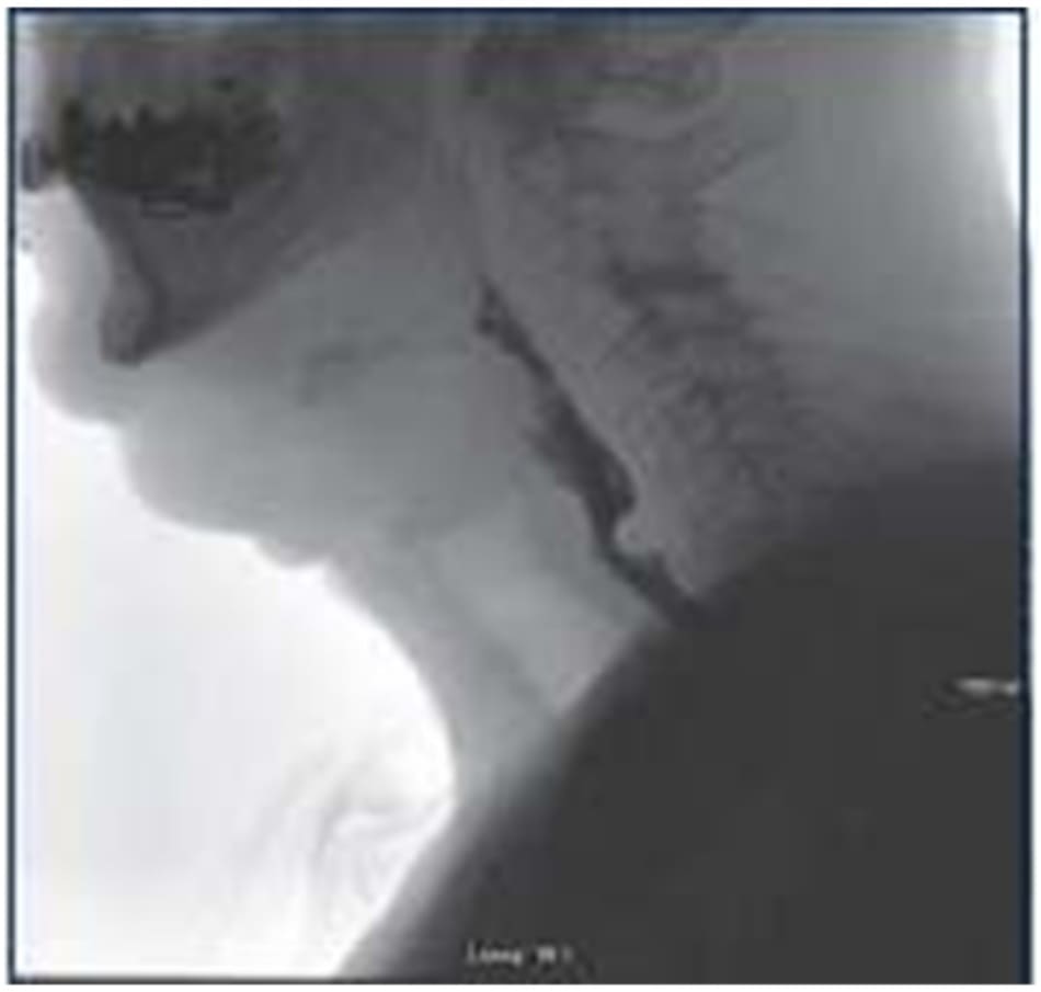 Figure 7–1. vfss view of a cricopharyngeal bar in an individual after radiation treatment for head and neck cancer.