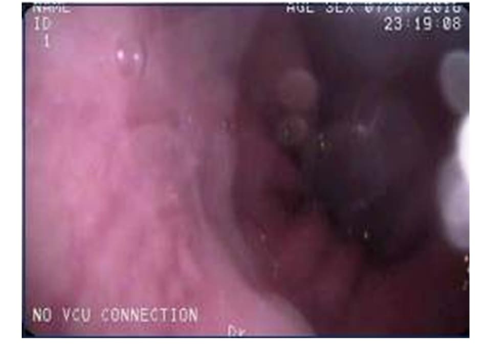 Figure 7–2.tneview of the z-line where the esophageal mucosa transitions to gastric mucosa. it is perturbations of this area and extension of ulcerations that should prompt biopsies to rule out barrett’s esophagus and other pathologies.