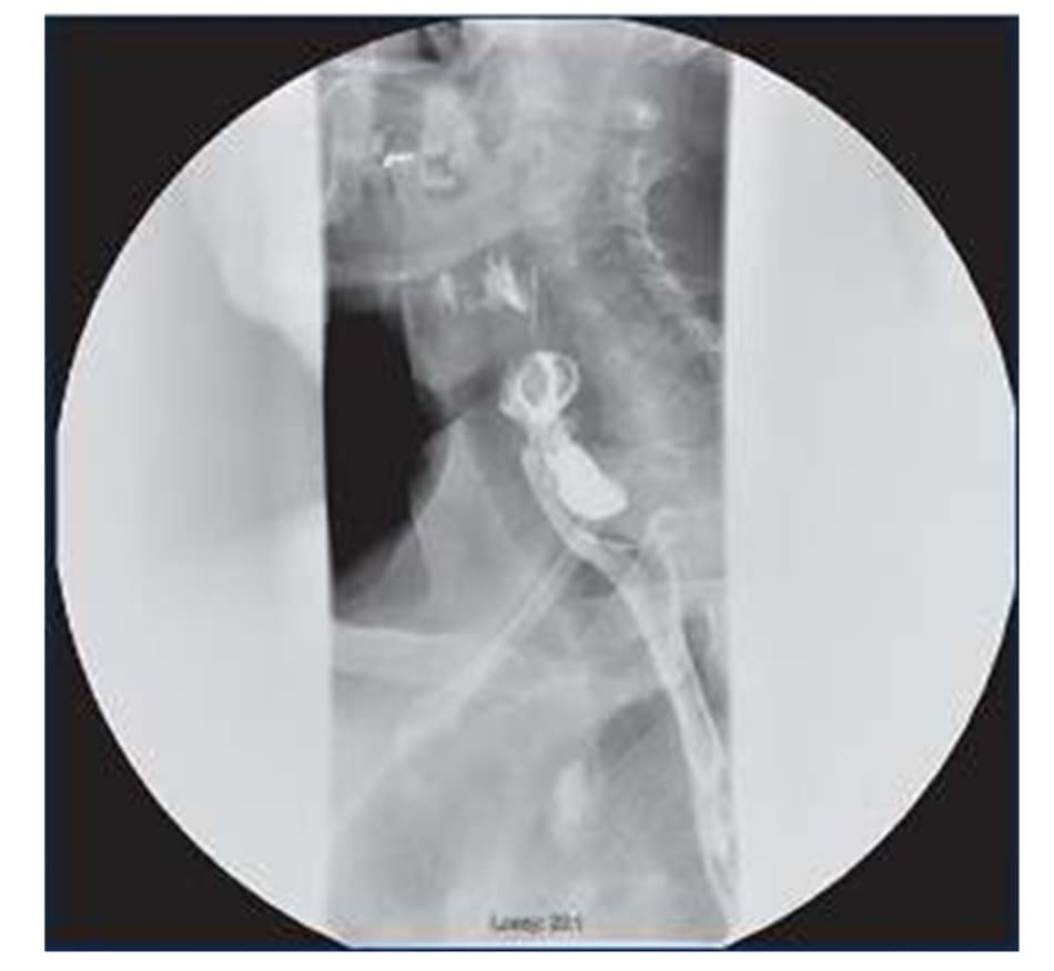 Figure 7–3.vfsslateral view of a Zenker’s diverticulum retaining barium contrast within it.