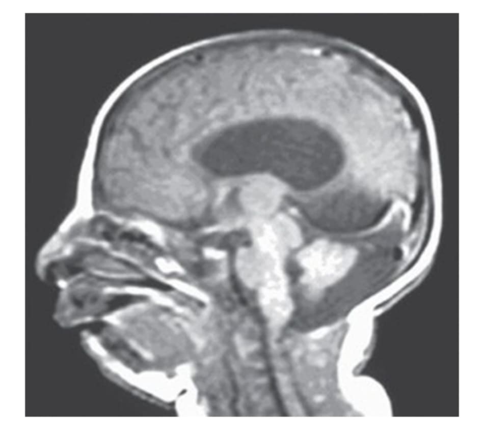 Hình 9.3 Hình ảnh cộng hưởng từ sọ não cho thấy tình trạng bất sản thể chai, thiểu sản tiểu não và bể lớn bất thường.