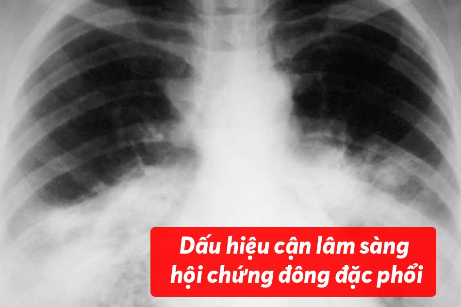 Dấu hiệu cận lâm sàng của hội chứng đông đặc phổi