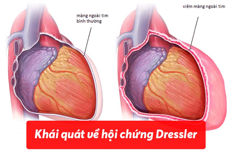 Khái quát hội chứng Dressler