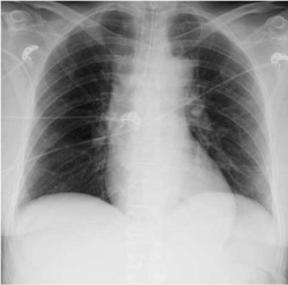 Hình 1: Chụp X quang ngực. Không có sự thâm nhiễm nào được nhìn thấy trên X quang phổi của bệnh nhân đã đặt nội khí quản và thở máy trong trường hợp này.