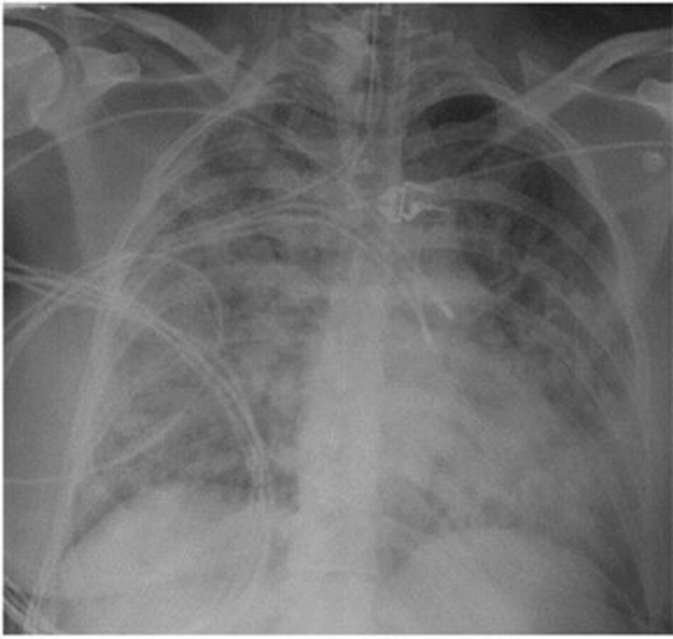 Hình 3: Chụp X quang ngực. Bệnh nhân này có thâm nhiễm hai bên X quang ngực; tuy nhiên hiện tại không yêu cầu thông khí cơ học.