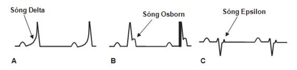Hình 2.12: Các sóng bất thường trên ECG. (A) Sóng Delta được đặc trưng bởi sự dốc lên chậm của phức bộ QRS do kích thích sớm (Hội chứng Wolff-Parkinson-White). (B) Sóng Osborn, giống như hình chữ "h" do hạ thân nhiệt và tăng canxi máu. (C) Sóng Epsilon được xem như một khía hình chữ V sau QRS ở V1, V 2, hoặc V3 chẩn đoán bệnh loạn sản thất phải sinh loạn nhịp.