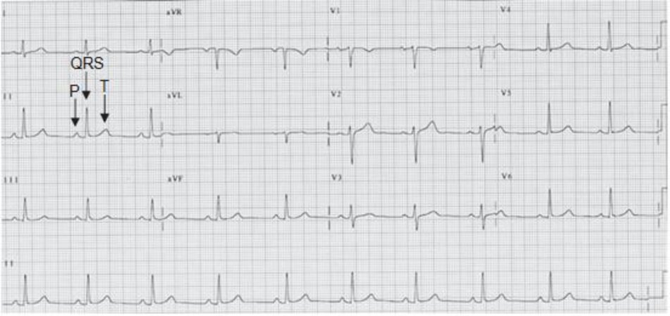 Hình 2.15: ECG bình thường. Nhịp xoang bình thường có tần số 62 l/phút.