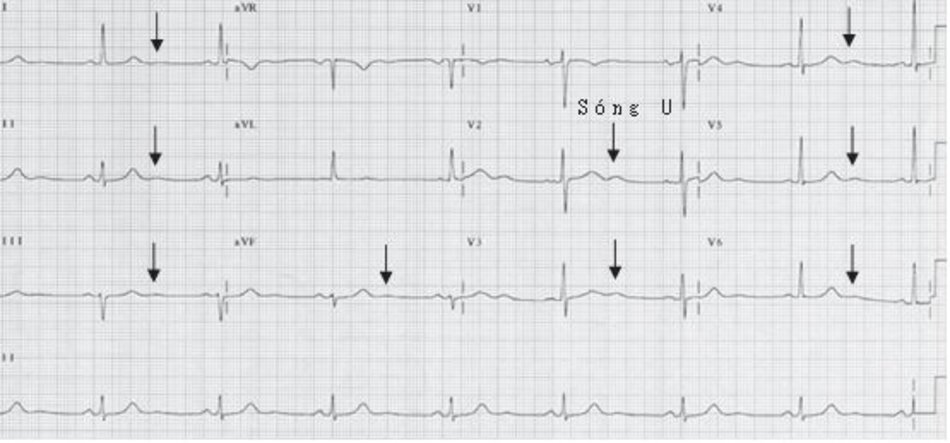 Hình 2.16: Sóng U nổi bật. ECG 12 chuyển đạo cho thấy sóng U ở hầu như tất cả các chuyển đạo. Sóng U thường được nhìn thấy khi tần số tim chậm và nổi bật rõ ở các chuyển đạo trước tim (V2 và V3) vì những chuyển đạo này nằm gần cơ thất nhất. Sóng U được đánh dấu bởi các mũi tên.